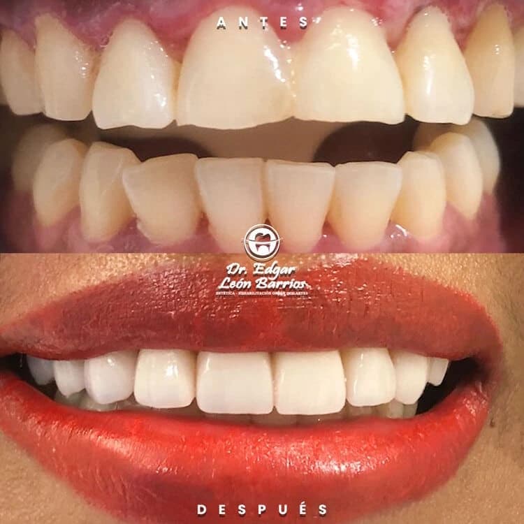 Transformación dental 1
