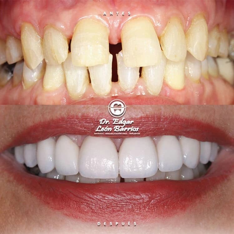 Transformación dental 3