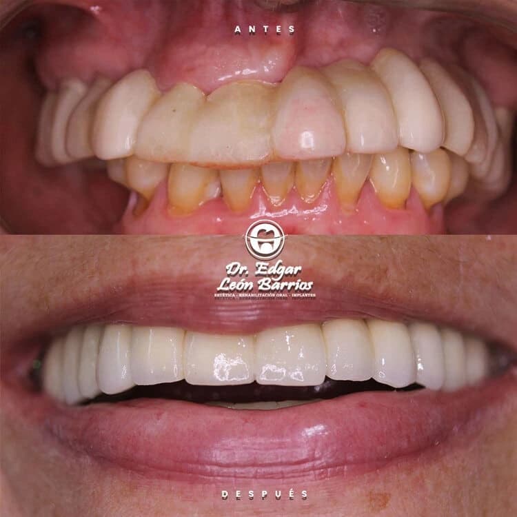 Transformación dental 4