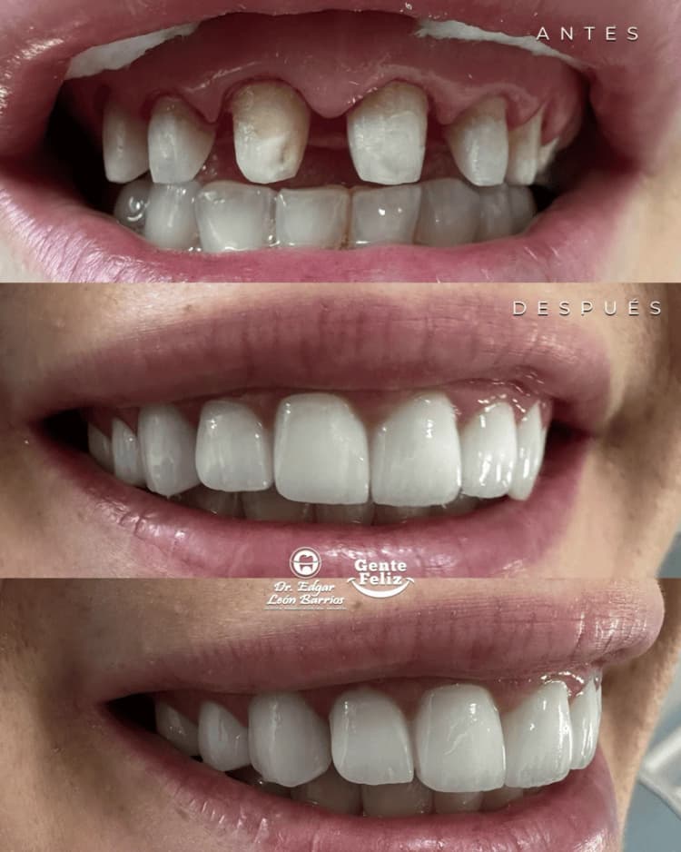 Transformación dental 5