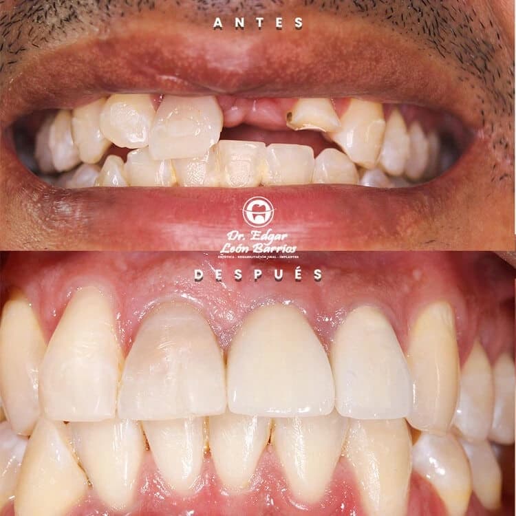 Transformación dental 6