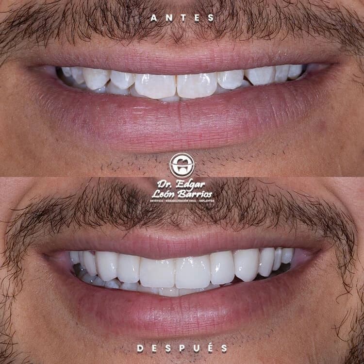 Transformación dental 9